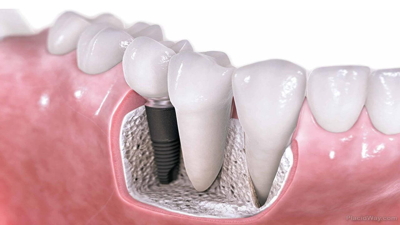 implant_dentar